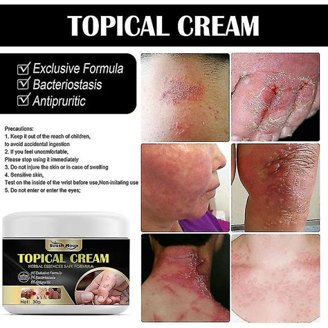 G Psoriasis Cream Eczema Ointment Scalp Psoriasis Hand Tinea Foot