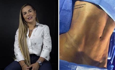 Veja O Antes E Depois Da Lipo Lad Realizado Pela