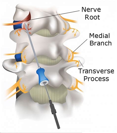 Facet Joint Nerve Block Injection