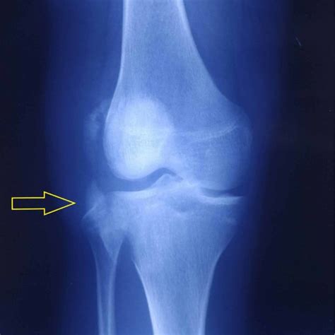 Anteroposterior And Lateral Radiographs Of The Knee At One Year Follow