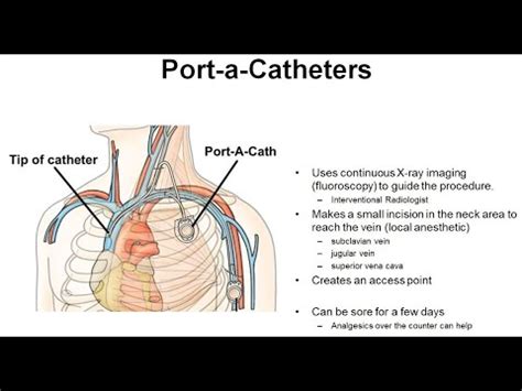 Principles Of Port A Cath Placement Management Youtube