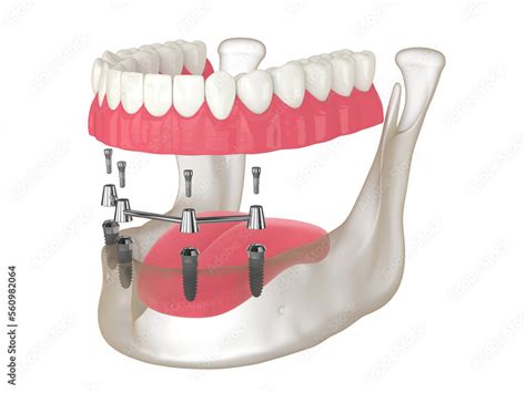 3d render of bar retained removable overdenture installation supported ...