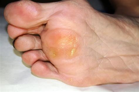 What Is Callus And How Is It Treated Exnol