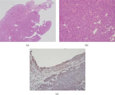 Figure From Intravascular Glomus Tumor Of The Forearm Causing Chronic