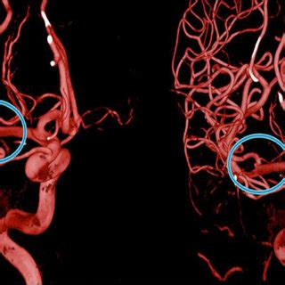 Cerebral Angiography In 2020 Left With Cerebral Angiography In 2021