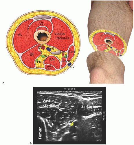 Saphenous Nerve Block Ultrasound