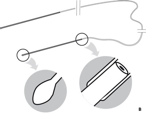 Nasolacrimal Stents An Introductory Guide