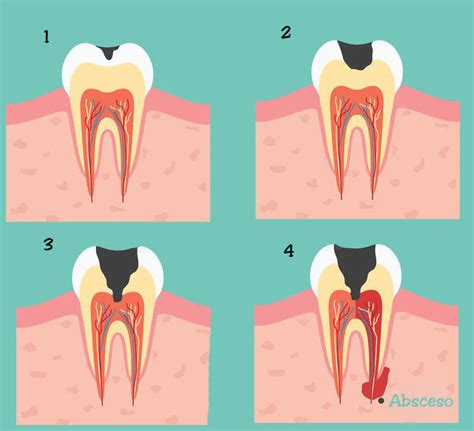 Cuanto Cuesta Quitar Una Caries Un Precio Justo