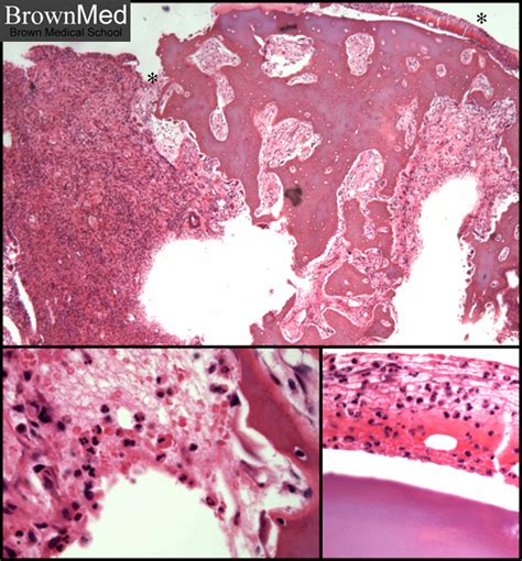 Acute Osteomyelitis