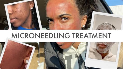 Microneedling Treatment For Acne Scars My Experience Youtube