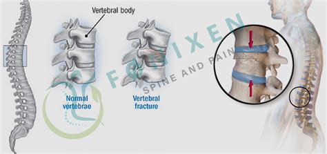 Vertebral Compression Fracture Treatment near me in Hyderabad