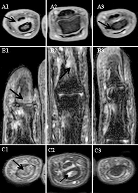 Axial A T1 Weighted Fse Images With Fsfs Post Gadolinium Enhancement