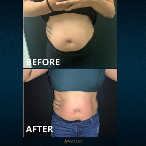 ultrasonic cavitation   body transformation hack