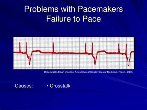 Pacemakers Ppt Download