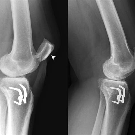 Left Panel Lateral Radiographic View Of The Left Knee Demonstrated Download Scientific Diagram