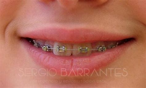 Durante cuánto tiempo se llevan los brackets