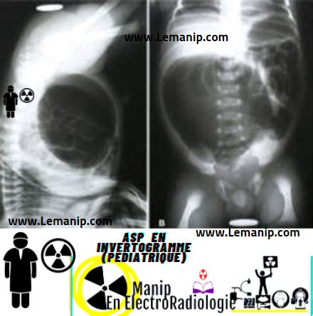 ASP Abdomen Sans Preparation pédiatrique