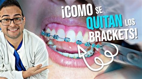 Como Se Quitan Los Brackets Y Se Ponen Los Retenedores Retiro De