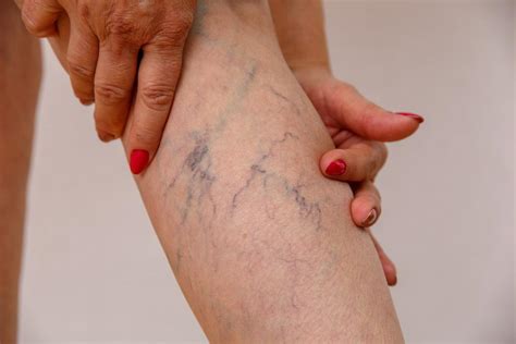 The Differences Between Varicose Veins And Spider Vein Kishore K