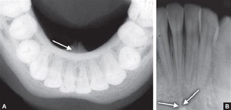 Genial Tubercle Radiograph