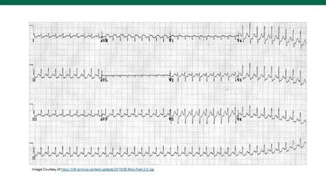 SVT on the ECG! — USF Emergency Medicine