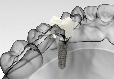 Ventajas De Las Impresiones Digitales Sobre Implantes Estudi Dental