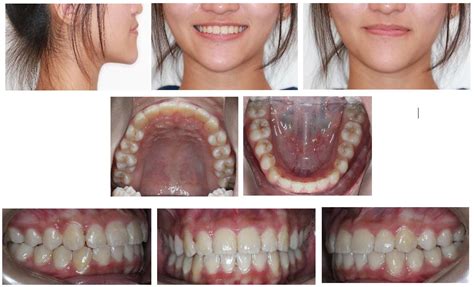 Class II Div I Bimaxillary Proclination Treated Non Extraction