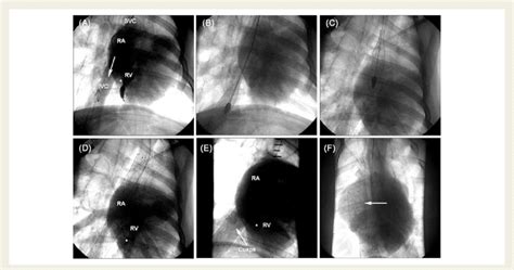 Implantation Procedure A Right Ventricular Angiogram Demonstrating