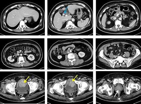 Synchronous Urinary Bladder And Prostate Cancer Radiology Cases