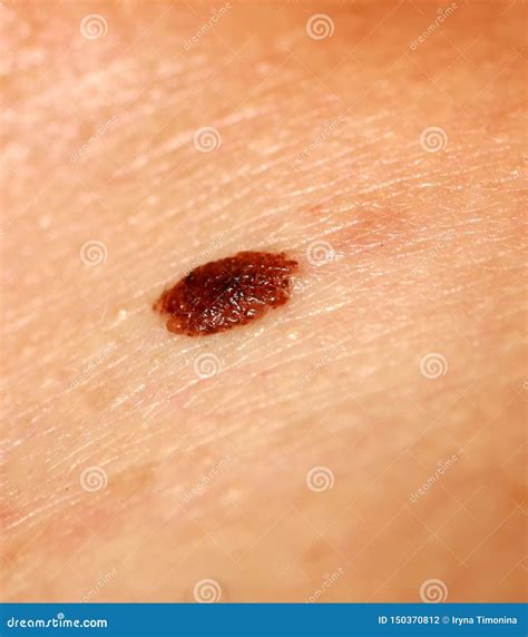 Brown Birthmark Brown Mole Large Size Stock Photo Image Of Cancer