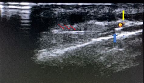 Transverse Ultrasound Image Of The Greater Occipital Nerve Blue