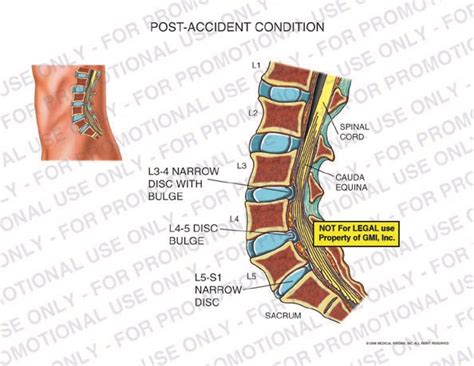 Post Accident Condition Of Lumbar Spine 96045a Generic Medical Legal Exhibits A Division Of Mvi