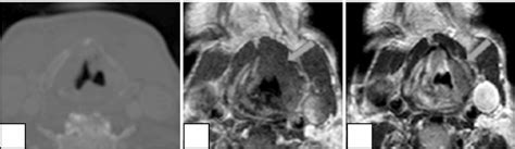 Male Patient Years Old With Pathologically Proven Laryngeal Cancer