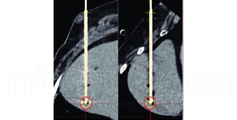 Needle Validation On A Ct Slice Along The Actual Needle Trajectory Download Scientific Diagram