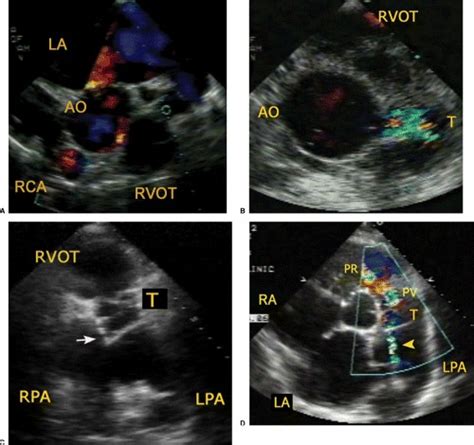 Two Dimensional Transesophageal And Transthoracic Echocardiography In