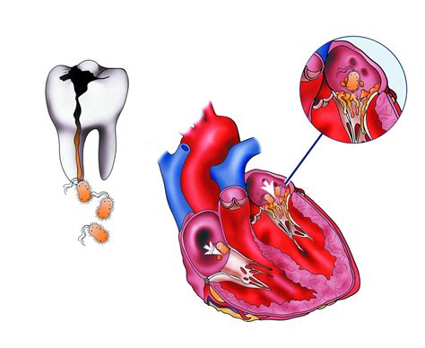 Endocarditis British Heart Valve Society