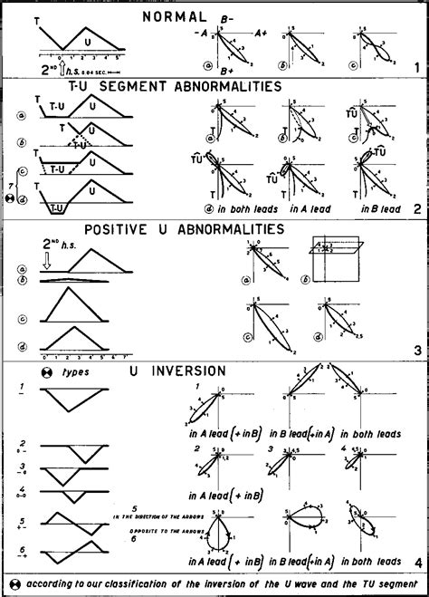 Figure 1 from Abnormality of the U Wave and of the T‐U Segment of the Electrocardiogram: The ...