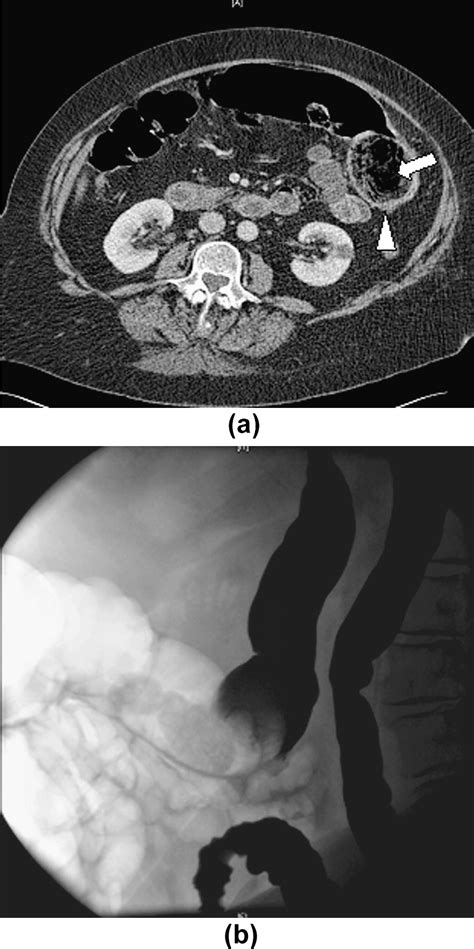 Imaging Manifestations Of Faecal Impaction And Stercoral Perforation Clinical Radiology