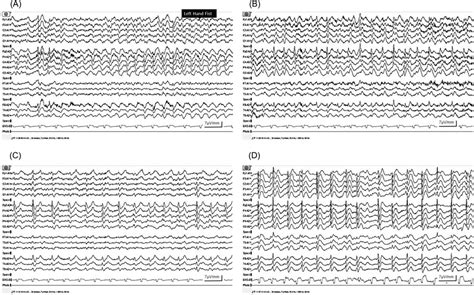 A Ictal Eeg Showing Rhythmic Discharges Arising From The Right