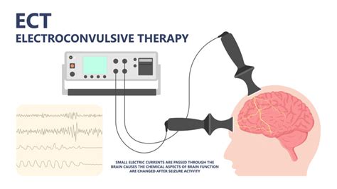 Comprehensive Guide To Tinnitus Treatments Explained Everything You