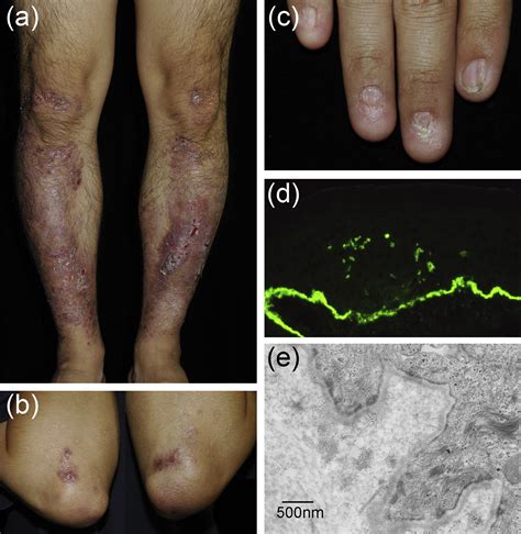 Recessive Dystrophic Epidermolysis Bullosa Identification Of A Novel