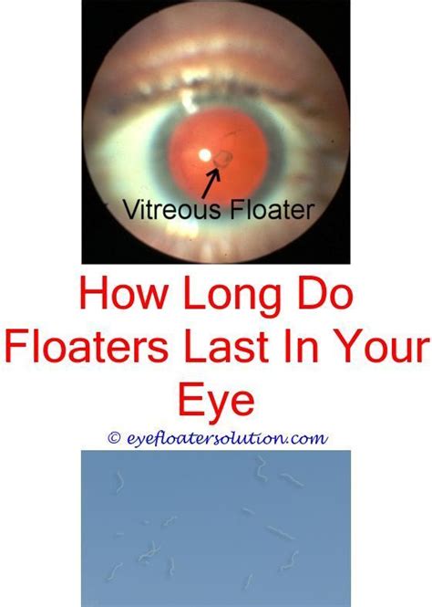 Eye Floaters Naturopath Seeing Black Floaters In Right Eye Eye