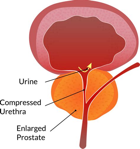 About Bph Causes Symptoms Treatments