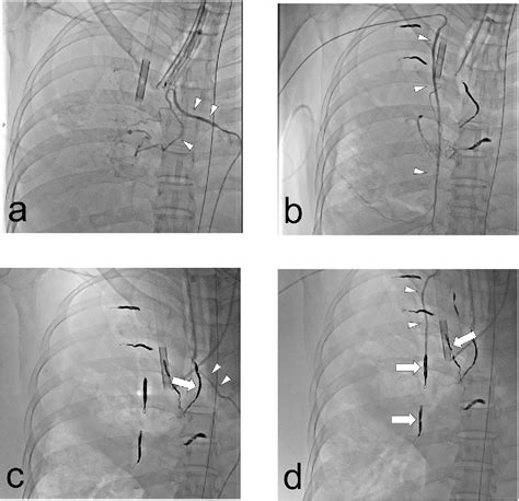 Figure From Successful Bronchial Artery Embolization Using Hydrogel