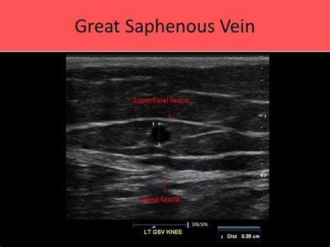 Ultrasound Registry Review - Extremity Venous