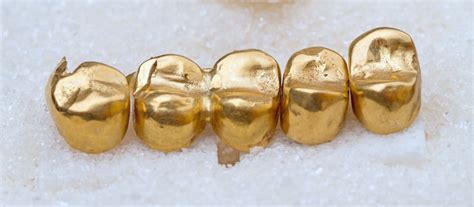 Silver Or Gold Dental Crown And Bridges Amazing Smiles