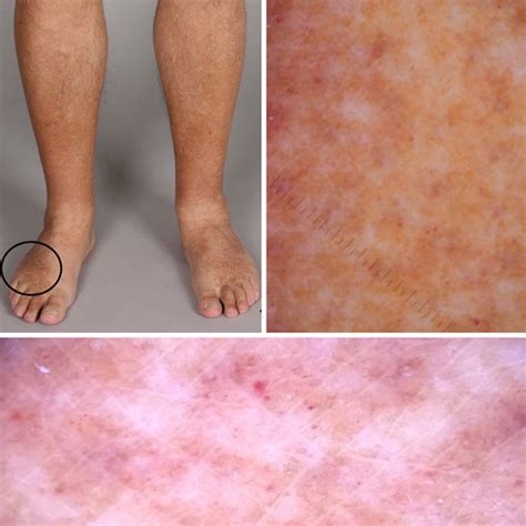 A Overview Image Of A 62 Year Old Patient With A Pigmented Purpuric