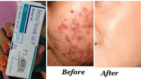 Benzoyl Peroxide Gel Pimples Will Go In 3 Days Guaranteed 3 दिन में