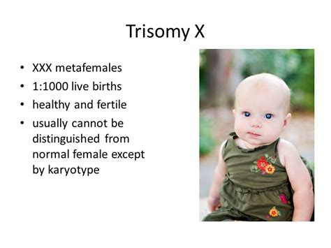 Down Syndrome Trisomy 21 Ppt Download