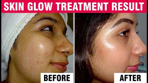 Acne Scar Specialist Pigmentation Or Dark Circles Treatments